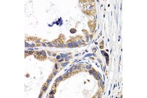 Immunohistochemistry of paraffin-embedded human stomach cancer using F antibody (ABIN6129515, ABIN6140420, ABIN6140421 and ABIN6220936) at dilution of 1:200 (40x lens). (FABP3 Antikörper  (AA 1-133))