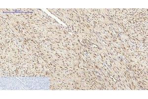 Immunohistochemistry of paraffin-embedded Human uterus cancer tissue using HSP70 Monoclonal Antibody at dilution of 1:200. (HSP70 Antikörper)
