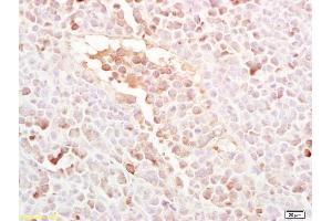 Formalin-fixed and paraffin embedded mouse colon carcinoma labeled with Rabbit Anti LRP5 Polyclonal Antibody, Unconjugated (ABIN754078) at 1:200 followed by conjugation to the secondary antibody and DAB staining