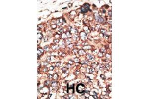 Formalin-fixed and paraffin-embedded human hepatocellular carcinoma tissue reacted with MMP17 polyclonal antibody  , which was peroxidase-conjugated to the secondary antibody, followed by DAB staining. (MMP17 Antikörper  (Internal Region))