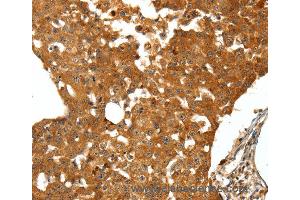 Immunohistochemistry of Human thyroid cancer using SSTR1 Polyclonal Antibody at dilution of 1:50