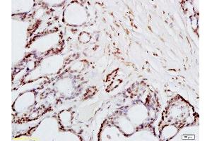 Formalin-fixed and paraffin embedded human colon carcinoma tissue labeled with Anti-FRA2/FOSL2 Polyclonal Antibody, Unconjugated  at 1:200 followed by conjugation to the secondary antibody and DAB staining (FOSL2 Antikörper  (AA 231-326))