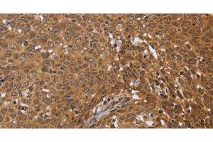 Immunohistochemistry of paraffin-embedded Human cervical cancer using FKBP8 Polyclonal Antibody at dilution of 1:50 (FKBP8 Antikörper)