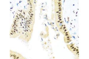 Immunohistochemistry of paraffin-embedded Human liver damage using ZBTB17 Polyclonal Antibody at dilution of 1:100 (40x lens). (ZBTB17 Antikörper)