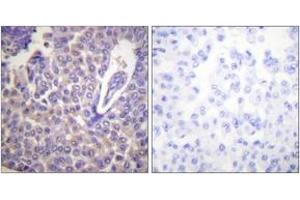 Immunohistochemistry analysis of paraffin-embedded human breast carcinoma, using Calnexin (Phospho-Ser583) Antibody. (Calnexin Antikörper  (pSer583))