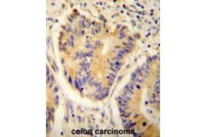 ADH4 antibody(C-term) immunohistochemistry analysis in formalin fixed and paraffin embedded human colon carcinoma followed by peroxidase conjugation of the secondary antibody and DAB staining. (ADH4 Antikörper  (C-Term))