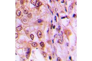 Immunohistochemical analysis of Cyclin D1 (pT286) staining in human breast cancer formalin fixed paraffin embedded tissue section.