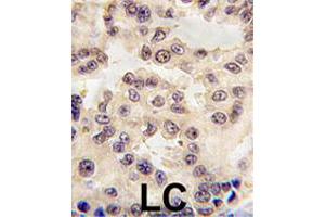 Formalin-fixed and paraffin-embedded human lung carcinoma tissue reacted with EN1 polyclonal antibody  , which was peroxidase-conjugated to the secondary antibody, followed by DAB staining. (EN1 Antikörper  (N-Term))