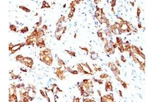 Formalin-fixed, paraffin-embedded human breast carcinoma stained with HSP27 antibody (HSPB1/774) (HSP27 Antikörper)