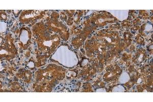 Immunohistochemistry of paraffin-embedded Human thyroid cancer tissue using MEIS1 Polyclonal Antibody at dilution 1:30 (MEIS1 Antikörper)
