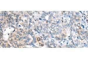 Immunohistochemistry of paraffin-embedded Human liver cancer tissue using CES2 Polyclonal Antibody at dilution of 1:55(x200) (CES2 Antikörper)