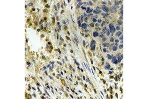 Immunohistochemical analysis of ALDH4A1 staining in human esophageal cancer formalin fixed paraffin embedded tissue section. (ALDH4A1 Antikörper)