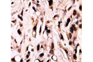 IHC analysis of FFPE breast carcinoma stained with phospho-SMAD4 antibody. (SMAD4 Antikörper  (pThr277))