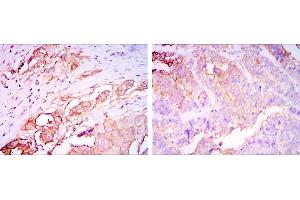 Immunohistochemical analysis of paraffin-embedded rectum cancer tissues (left) and stomach cancer tissues (right) using CEA mouse mAb with DAB staining. (CEA Antikörper)