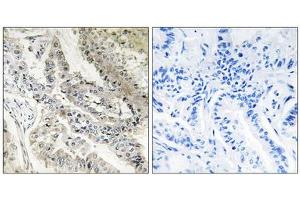 Immunohistochemistry analysis of paraffin-embedded human lung carcinoma tissue, using CRBP III antibody. (Retinol Binding Protein 5 Antikörper  (N-Term))