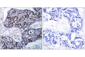 Immunohistochemistry analysis of paraffin-embedded human breast carcinoma tissue, using Integrin beta3 (Ab-785) Antibody. (Integrin beta 3 Antikörper  (AA 739-788))
