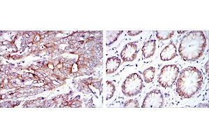 Immunohistochemical analysis of paraffin-embedded stomach cancer tissues (left) and stomach tissues (right) using KRT19 mouse mAb with DAB staining.