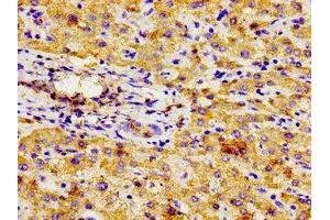 Immunohistochemistry of paraffin-embedded human liver cancer using ABIN7145059 at dilution of 1:100 (NPR3 Antikörper  (AA 36-127))