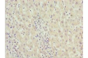 Immunohistochemistry of paraffin-embedded human liver cancer using ABIN7176530 at dilution of 1:100 (ZNF785 Antikörper  (AA 1-200))