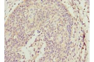 Immunohistochemistry of paraffin-embedded human cervical cancer using ABIN7143769 at dilution of 1:100 (ALG2 Antikörper  (AA 197-416))
