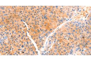 Immunohistochemistry of paraffin-embedded Human liver cancer using PRDX2 Polyclonal Antibody at dilution of 1:80 (Peroxiredoxin 2 Antikörper)