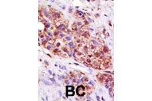 Formalin-fixed and paraffin-embedded human cancer tissue reacted with the primary antibody, which was peroxidase-conjugated to the secondary antibody, followed by DAB staining. (UBE2B Antikörper  (C-Term))