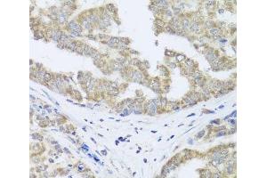 Immunohistochemistry of paraffin-embedded Human liver cancer using TIMM10B Polyclonal Antibody at dilution of 1:100 (40x lens). (TIMM10B Antikörper)