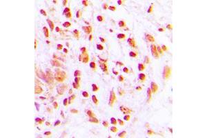Immunohistochemical analysis of Histone H4 (AcK16) staining in human lung cancer formalin fixed paraffin embedded tissue section. (Histone H4 Antikörper  (acLys16, N-Term))