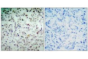 Immunohistochemical analysis of paraffin- embedded human breast carcinoma tissue, using Rb (phospho-Ser780) antibody (E011132) . (Retinoblastoma 1 Antikörper  (pSer780))