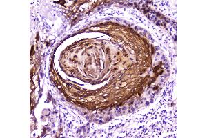 IHC analysis of FABP5 using anti-FABP5 antibody . (FABP5 Antikörper)