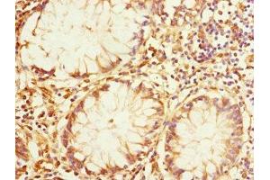 Immunohistochemistry of paraffin-embedded human colon cancer using ABIN7167162 at dilution of 1:100 (IQGAP3 Antikörper  (AA 1437-1631))