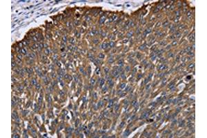 The image on the left is immunohistochemistry of paraffin-embedded Human lung cancer tissue using ABIN7130044(KRT31 Antibody) at dilution 1/30, on the right is treated with fusion protein. (Keratin 31 Antikörper)