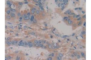Detection of Hpt in Human Breast cancer Tissue using Polyclonal Antibody to Haptoglobin (Hpt) (Haptoglobin Antikörper  (AA 44-157))