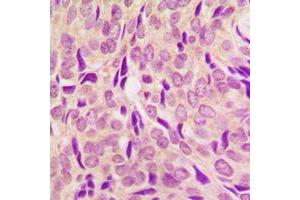 Immunohistochemical analysis of RPS6 (pS240) staining in human breast cancer formalin fixed paraffin embedded tissue section.