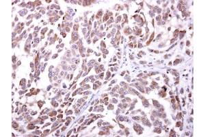 IHC-P Image NKG2D antibody [N3C2], Internal detects NKG2D protein at cytosol on human lung carcinoma by immunohistochemical analysis.