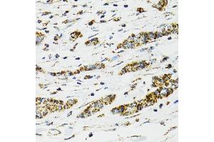 Immunohistochemistry of paraffin-embedded human breast cancer using HSPA9 antibody (ABIN5970207) at dilution of 1/100 (40x lens). (HSPA9 Antikörper)