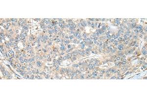 Immunohistochemistry of paraffin-embedded Human liver cancer tissue using CASR Polyclonal Antibody at dilution of 1:60(x200)