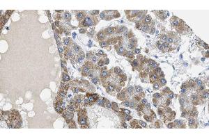 ABIN6269057 at 1/100 staining Human liver cancer tissue by IHC-P. (MAP3K7 Antikörper  (Internal Region))