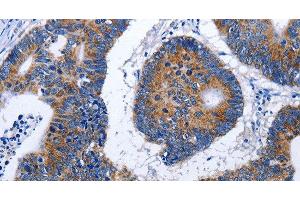 Immunohistochemistry of paraffin-embedded Human colon cancer using EEF1 gamma Polyclonal Antibody at dilution of 1:50