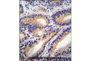 HSD11B1L Antibody immunohistochemistry analysis in formalin fixed and paraffin embedded human prostate carcinoma followed by peroxidase conjugation of the secondary antibody and DAB staining. (HSD11B1L Antikörper  (C-Term))