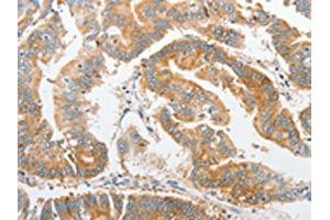 The image on the left is immunohistochemistry of paraffin-embedded Human colon cancer tissue using ABIN7128369(ALPI Antibody) at dilution 1/25, on the right is treated with fusion protein. (Intestinal Alkaline Phosphatase Antikörper)