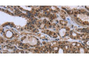 Immunohistochemistry of paraffin-embedded Human thyroid cancer using GGCX Polyclonal Antibody at dilution of 1:50