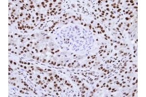 Immunohistochemical staining of paraffin-embedded A549 Xenograft using hnRNP F antibody at a dilution of 1:100 (HNRNPF Antikörper)