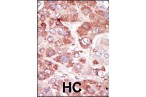 Formalin-fixed and paraffin-embedded human cancer tissue reacted with the primary antibody, which was peroxidase-conjugated to the secondary antibody, followed by AEC staining. (GRK7 Antikörper  (C-Term))