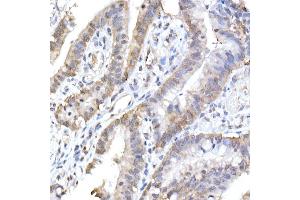 Immunohistochemistry of paraffin-embedded human colon carcinoma using HINT1 Rabbit mAb (ABIN7267663) at dilution of 1:50 (40x lens). (HINT1 Antikörper)
