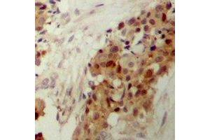 Immunohistochemical analysis of p38 (pY182) staining in human breast cancer formalin fixed paraffin embedded tissue section. (MAPK14 Antikörper  (pTyr182))