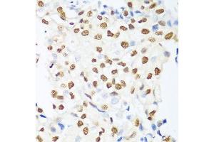 Immunohistochemistry of paraffin-embedded human prostate cancer using HDAC1 antibody. (HDAC1 Antikörper  (AA 393-482))