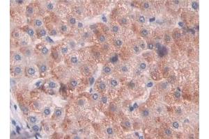 Detection of HIF1a in Human Liver cancer Tissue using Polyclonal Antibody to Hypoxia Inducible Factor 1 Alpha (HIF1a) (HIF1A Antikörper  (AA 218-506))