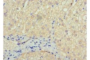 Immunohistochemistry of paraffin-embedded human liver cancer using ABIN7172606 at dilution of 1:100 (SOX14 Antikörper  (AA 1-137))