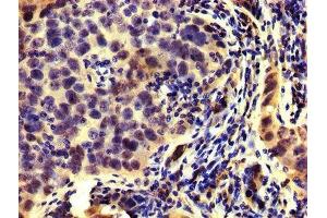 IHC image of ABIN7142292 diluted at 1:200 and staining in paraffin-embedded human pancreatic cancer performed on a Leica BondTM system. (HMGCR Antikörper  (AA 588-887))